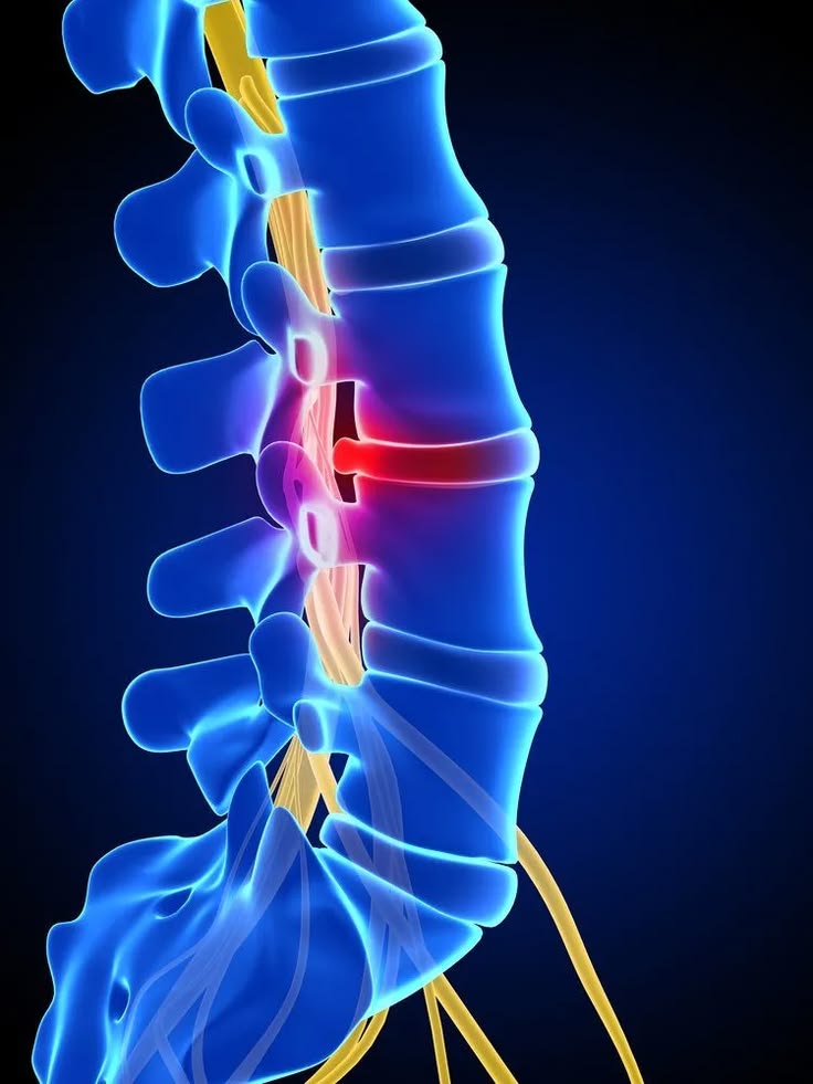 Herniated Disc Relief and Treatment